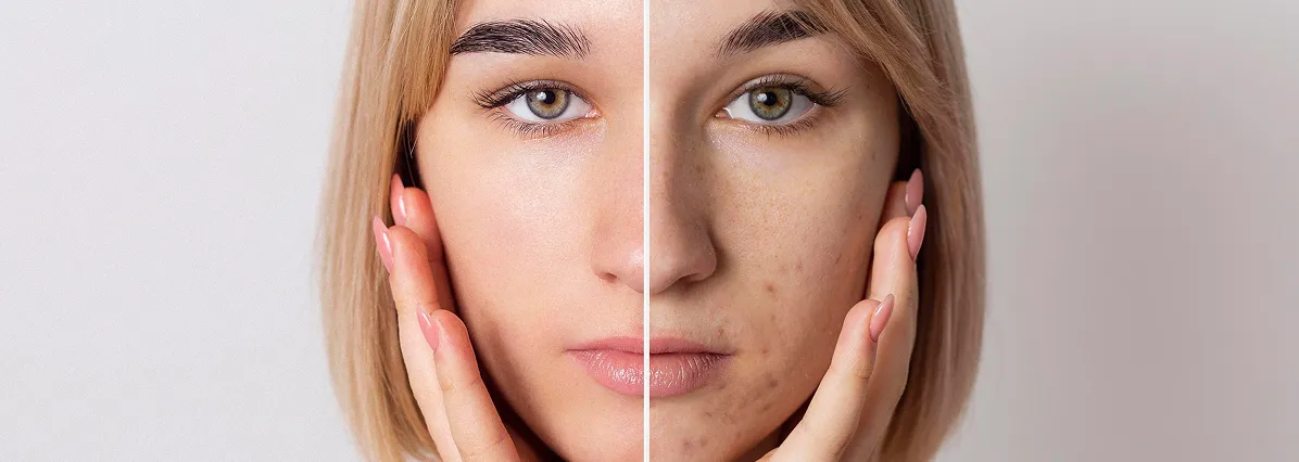 Hyperpigmentation Causes, Treatments & How To Achieve Even Toned Skin