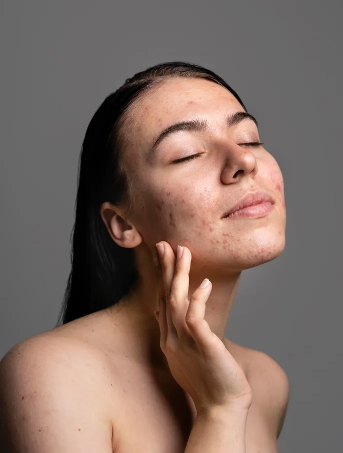 Featured Cosmelan The Ultimate Treatment For Stubborn Pigmentation