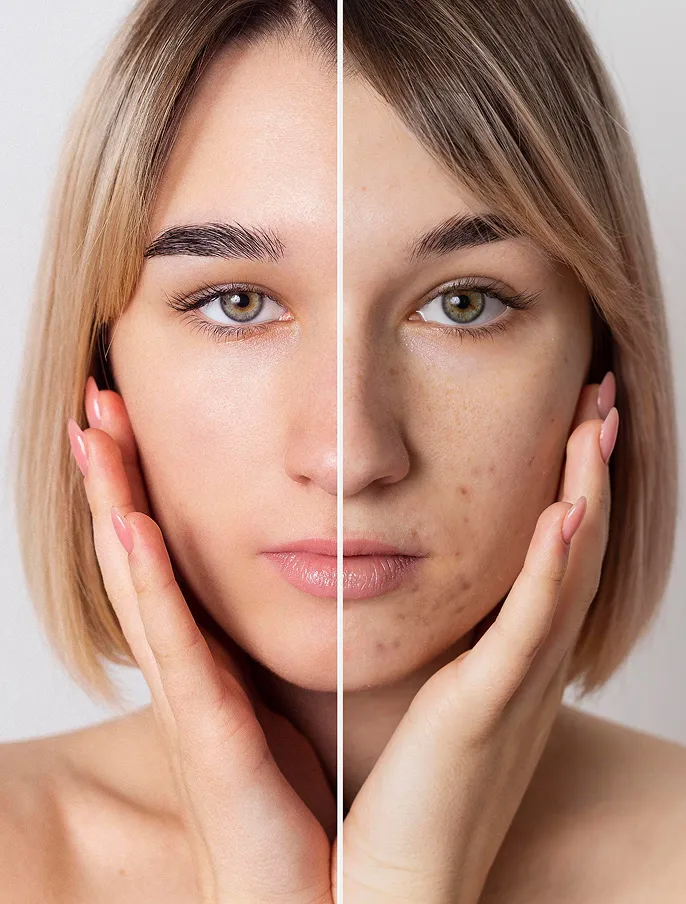 Featured Hyperpigmentation Causes, Treatments & How To Achieve Even Toned Skin